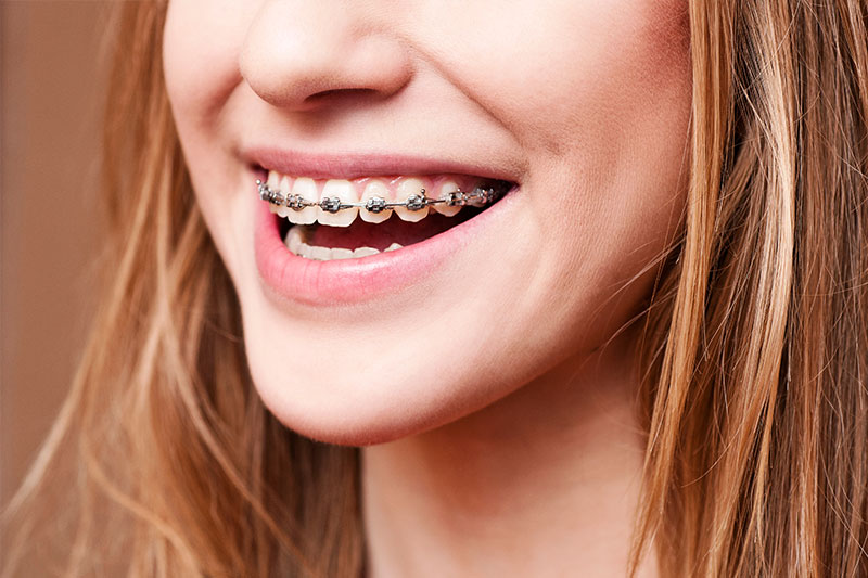 Orthodontics in Ventura