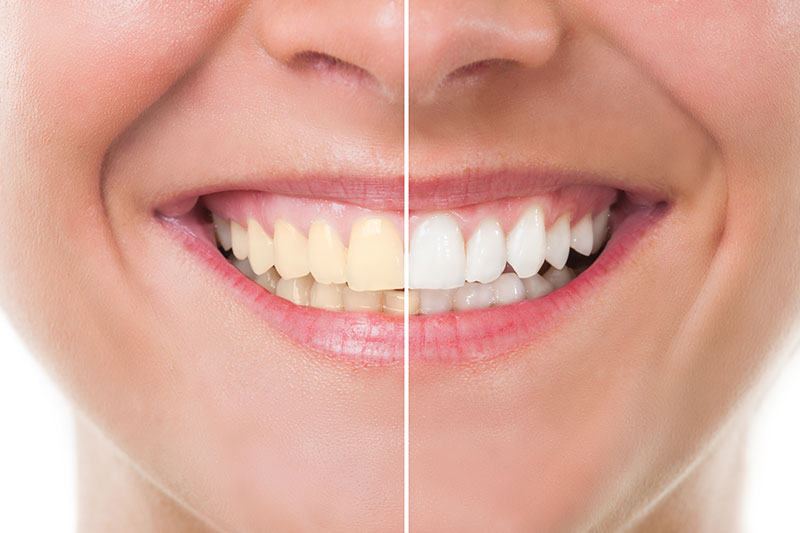 Teeth Whitening in Ventura